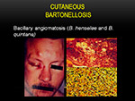 Cutaneous Bartonellosis