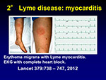  Lyme disease 