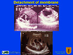 Detachment of membrane