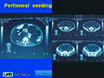 Peritoneal seeding