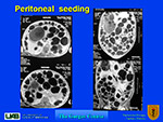 Peritoneal seeding