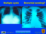 Multiple cysts