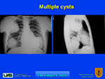 Multiple cysts