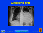 Giant lung cyst