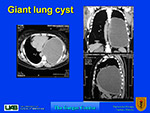 Giant lung cyst