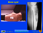 Bone cyst