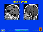 Brain cysts