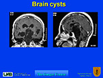 Brain cysts