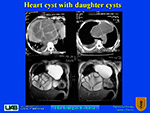 Heart cyst