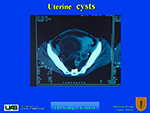 Uterine cysts