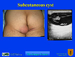 Subcutaneous cyst
