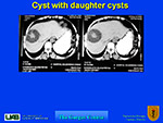 Cyst