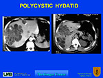 Polycystic Hydatid