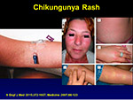  Chikungunya Rash