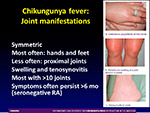  Chikungunya Fever 
