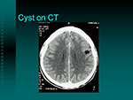 Cyst  on CT