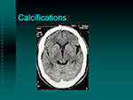 Calcifications