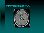 Intraventricular NCC