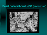 Basal Subarachnoid