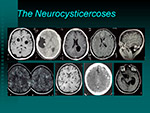 The Neurocysticercoses