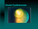 Ocular Cysticercosis