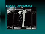 Muscle Calcifications