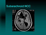 Subarachnoid NCC