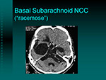 Basal Subarachnoid NCC
