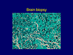  Brain Biopsy 