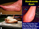 Hookworm Rash