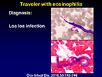  Traveler with eosinophilia 