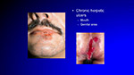 Chronic herpetic ulcers