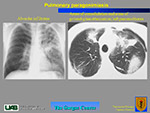 Pulmonary paragonimiasis