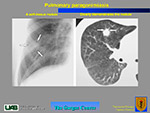  Pulmonary paragonimiasis 