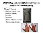 Chronic hypoxia