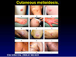 Cutaneous Melioidosis 