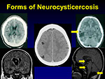 Forms of Neurocysticercosis