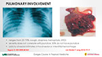 Pulmonary Involvement