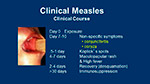 Clinical Measles
