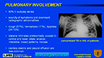 Pulmonary involvement