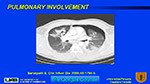  Pulmonary involvement 