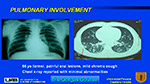  Pulmonary involvement 