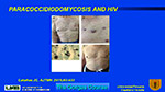  Paracoccidioidomycosis  and HIV
