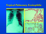 Tropical Pulmonary Eosinophilia