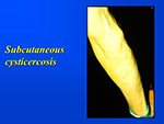 Subcutaneous cysticercosis