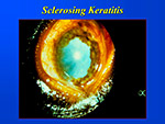 Sclerosing Keratitis