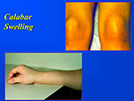 Calabar Swelling