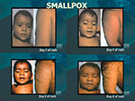  Smallpox 