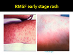 RMSF early stage