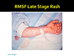  RMSF late stage 